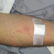 WFG dag 3 infuus irritatie 034
