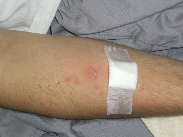 WFG dag 3 infuus irritatie 034